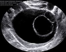 Image result for Dermoid Cyst Ovarian Gross Specimen
