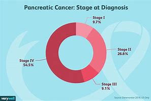 Image result for Pancreatic Cancer Stages