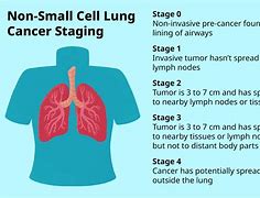 Image result for 2 Cm Nodule On Lung