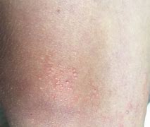 Image result for Molluscum On the Leg