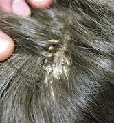 Image result for Dandruff Scabs On Scalp