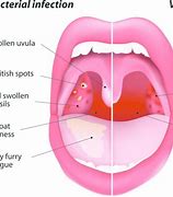 Image result for Sore Throat Tongue
