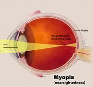 Image result for Red Eye Astigmatism