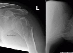 Image result for Humerus Bone Fracture Healing