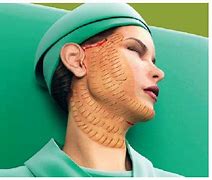 Image result for Acupuncture Face Lift