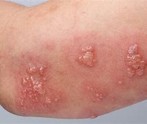 Image result for Shingles On Arm