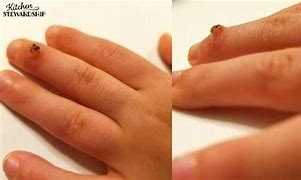 Image result for Warts On Kids Fingers
