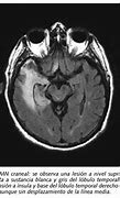 Image result for encefalonielitis