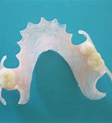 Image result for Flexible Partial Dentures