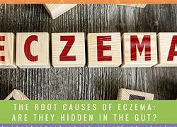 Image result for eczema cause