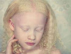 Image result for albinismi