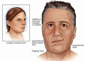 Image result for Signs of Bell's Palsy