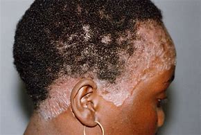 Image result for Scalp Psoriasis Symptoms