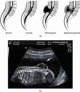 Image result for Meningocele Infant