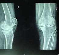 Image result for 膝关节炎