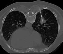 Image result for Lung Mass Biopsy