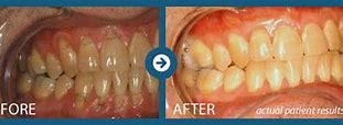 Image result for Receding Gum Recession