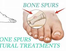 Image result for Bone Spur Treatment