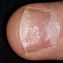 Image result for Abnormal Fingernails