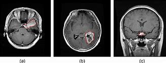 Image result for Meningioma Brain Tumor