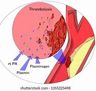 Image result for Process of Thrombolysis in Stroke