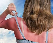 Image result for Itchy SunBurn