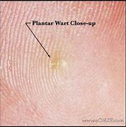 Image result for Plantar Wart Core