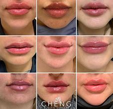 Image result for Lip Line Fillers Before and After