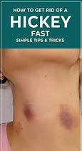 Image result for How to Get Rid of a Hickey Fast