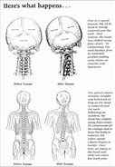 Image result for Atlas Subluxation Complex