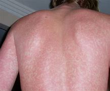 Image result for Rash Covering Entire Body