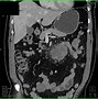 Image result for Small Bowel Carcinoid Tumor
