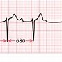 Image result for Mobitz Type 1 EKG
