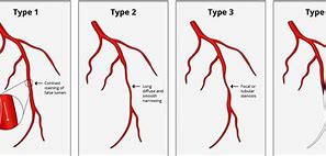 Image result for LAD Artery Types