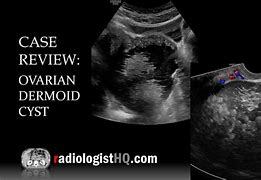 Image result for Dermoid Cyst Ultrasound