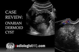 Image result for Dermoid Cyst On Ultrasound