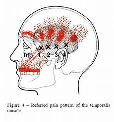 Referred Dental It Hurts But Where And Why There