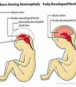Image result for Exancephaly