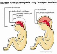 Image result for Anencephaly Neural Tube