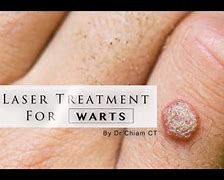 Image result for Warts Laser Treatment