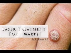Image result for Water Warts Treatment