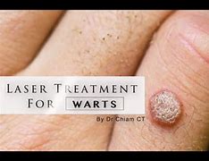 Image result for Hand Wart Removed