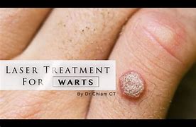 Image result for Stages of Wart Removal