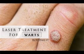 Image result for Wart After Removal
