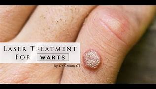 Image result for Large Wart Treatment