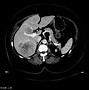 Image result for Carcinoid Tumor CT