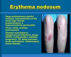 Image result for Erythema Nodosum