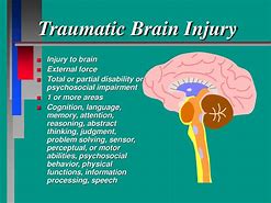 Image result for Mild Traumatic Brain Injury
