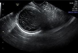 Image result for Hemorrhagic Ovarian Cyst On Ultrasound