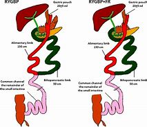 Image result for Ghrelin Gastric Bypass